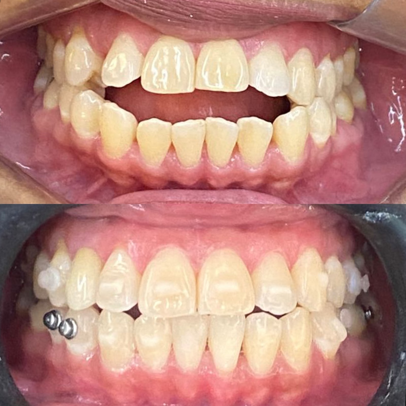 Antes e Depois Alinhador Invisível