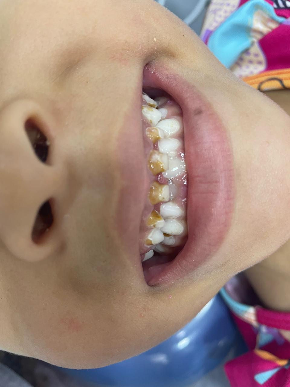 Antes - Reabilitação Estética