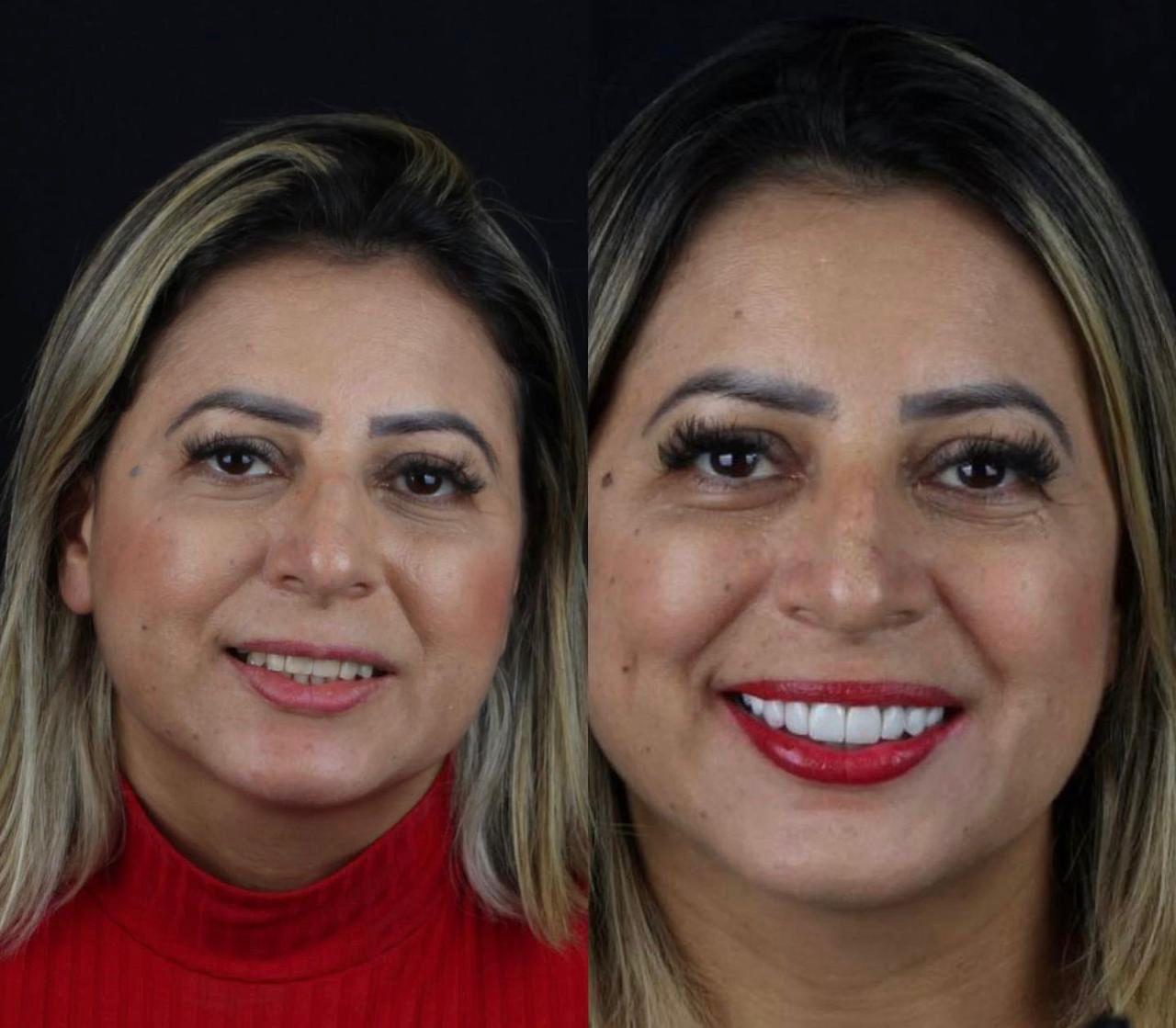 Transformação de Sorriso 1