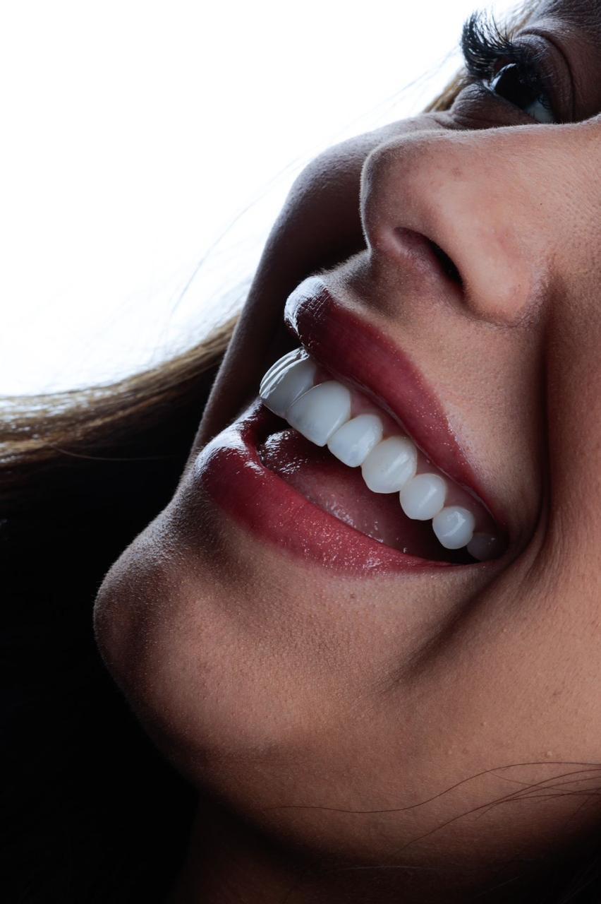 Resultado Lentes Dentárias