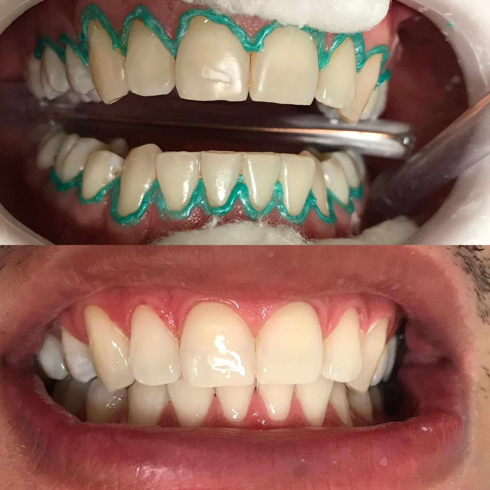 Antes e Depois Sorriso Gengival 2