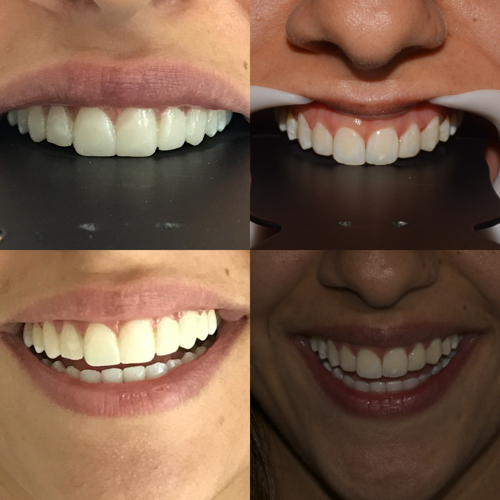 Antes e Depois Sorriso Gengival 3