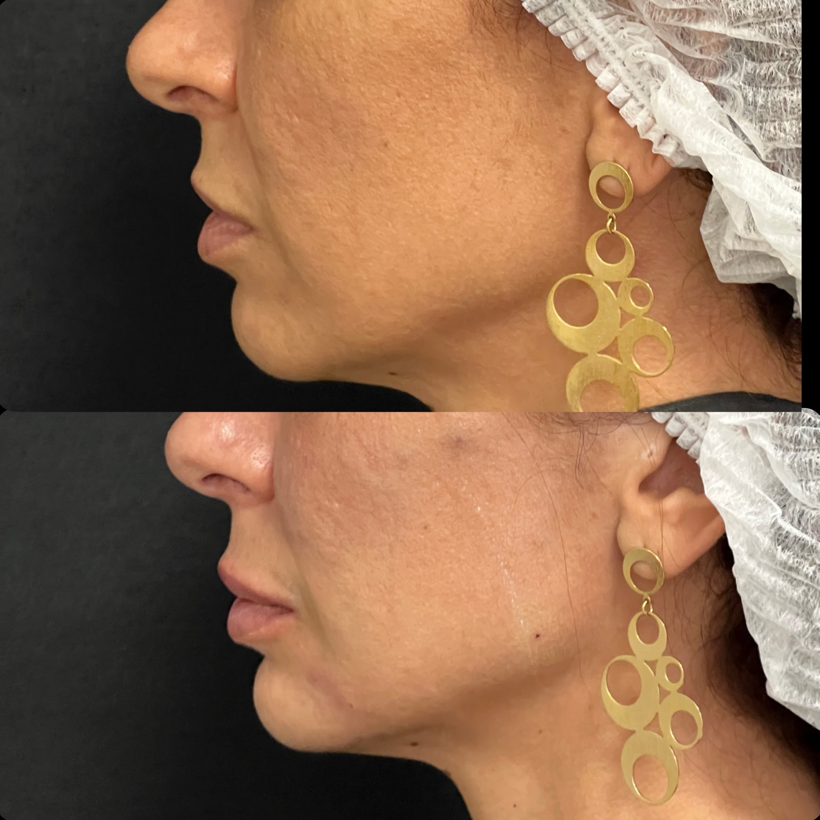 Antes e Depois Perfiloplastia
