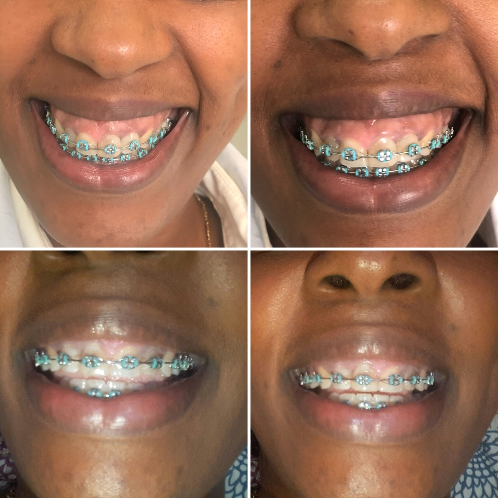Antes e Depois Sorriso Gengival 1